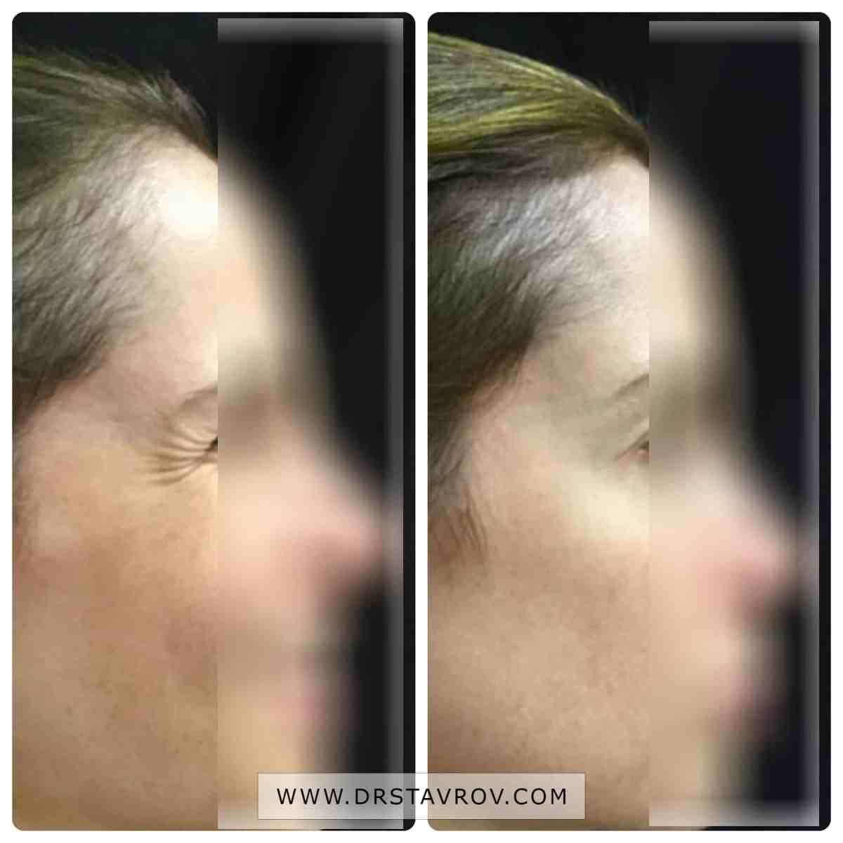 Wrinkles around the eyes. Crow's feet wrinkles. Price Dr. Stavrov