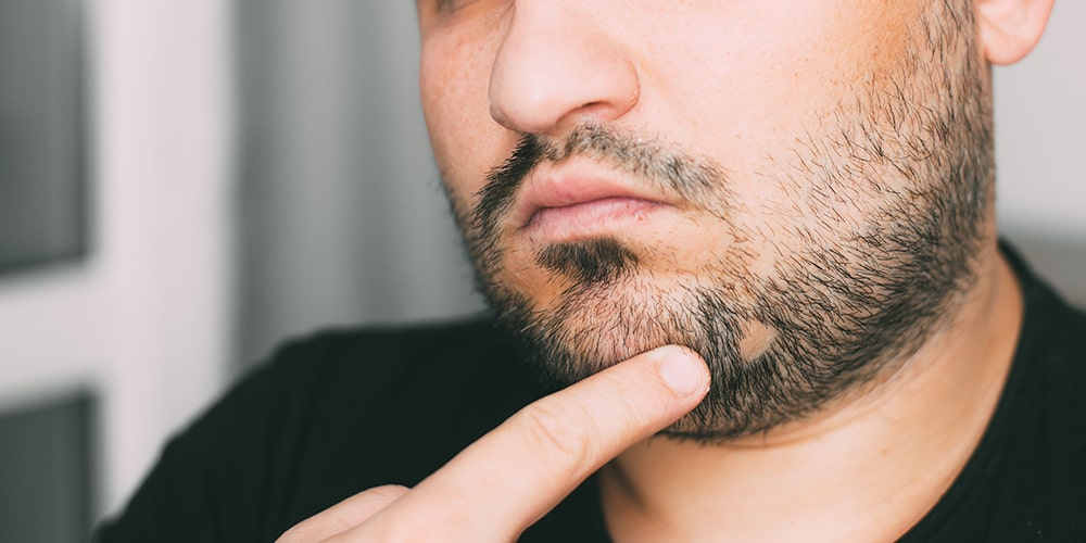 Alopecia areata на брадата